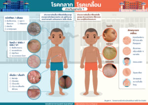 กลากเกลื้อน